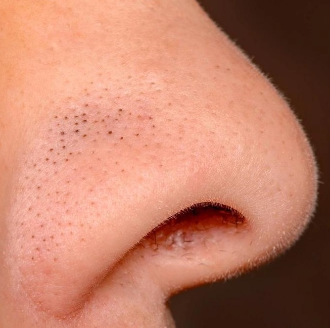 Mazové filamenty na nose